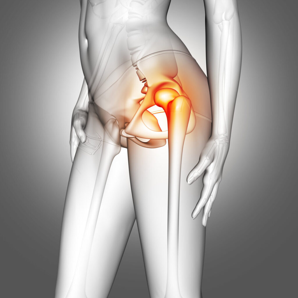 Fracture de la hanche : optimiser la prise en charge des patients âgés